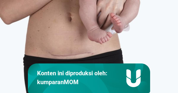 Tips Mengecilkan Perut Setelah Operasi Caesar - kumparan.com